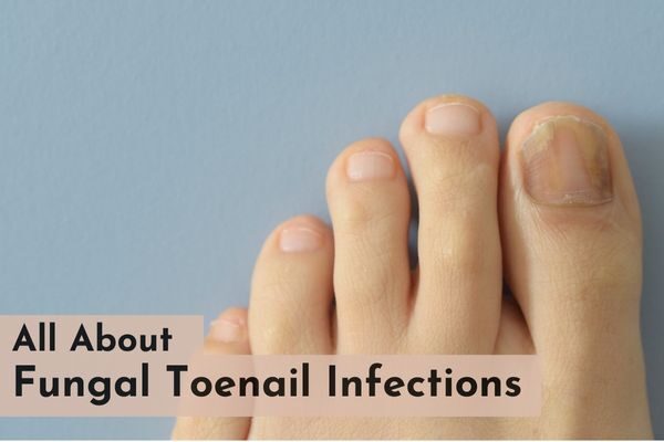 Fungal Nail Infection Treatment in Bangalore | Dr Tina Skin Solutionz