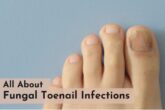 Learn about fungal toenail infections