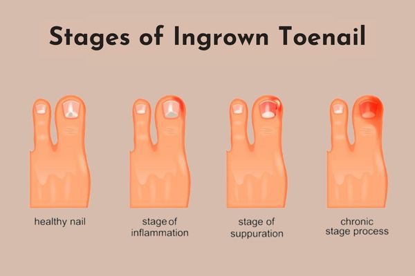 Stages of ngrown toenail
