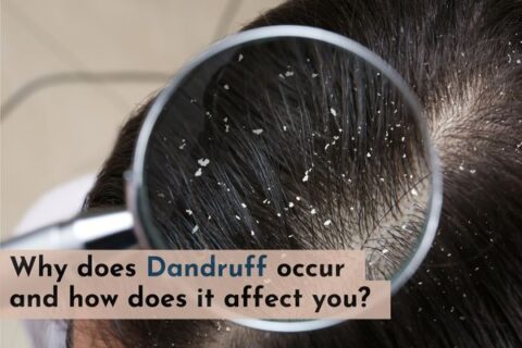 why dandruff occur