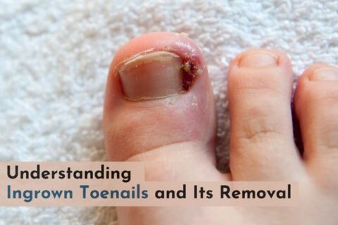 Ingrown toenail removal near saket