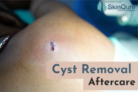 Cyst removal aftercare