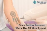 tattoo removal in delhi