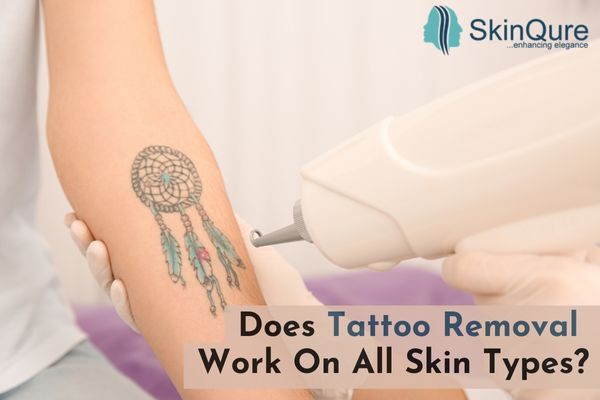 How is laser tattoo removal better than other tattoo removal methods? —  Edit Skin Clinic