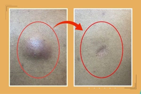cyst removal in saket