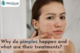 Pimples treatment in Delhi