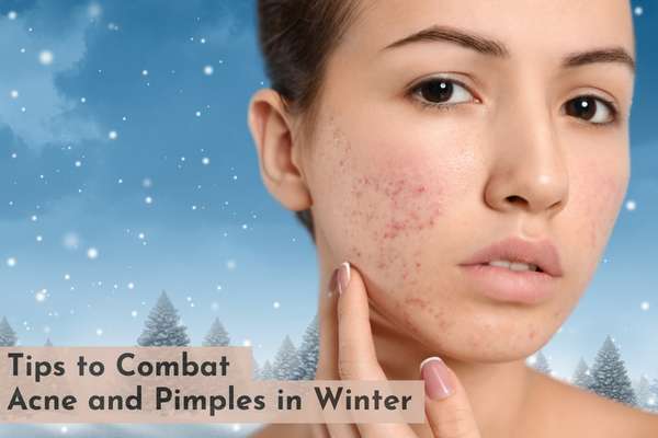 Learn These 7 Tips to Combat Acne and Pimples in Winter