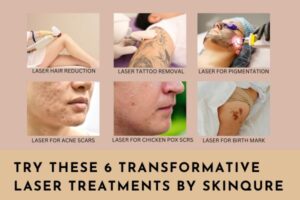 laser treatment in saket