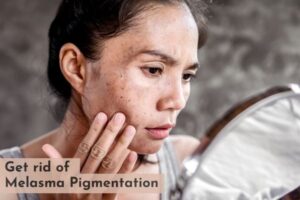 Melasma treatment in Saket