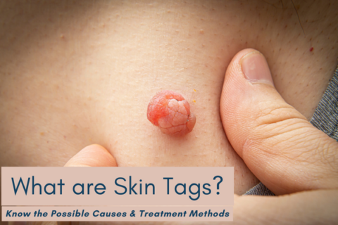 all about skin tags