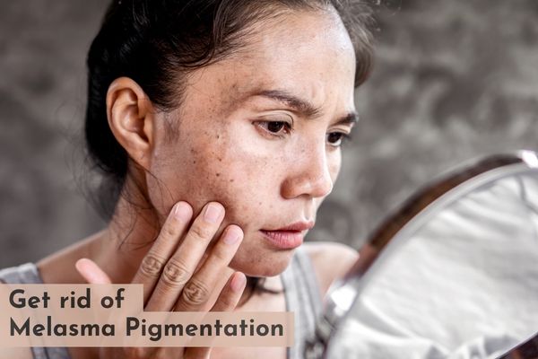 Melasma treatment in Saket