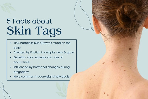 facts about skin tags