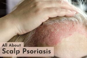 scalp psoriasis treatment in delhi