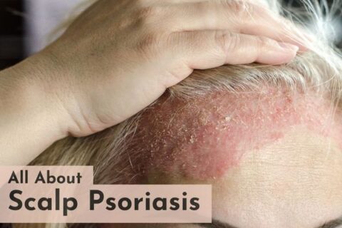 scalp psoriasis treatment in delhi