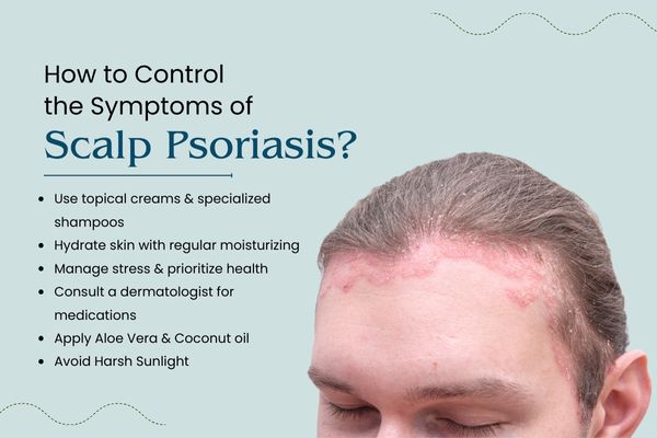 scalp psoriasis solution delhi