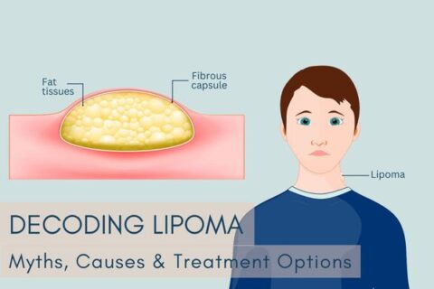 Lipoma removal in Delhi
