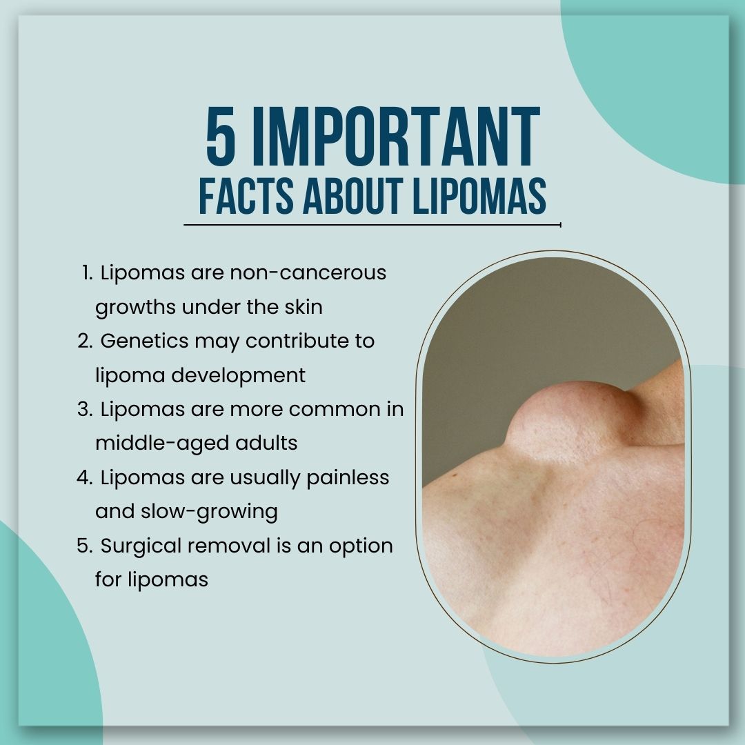 Facts about lipoma