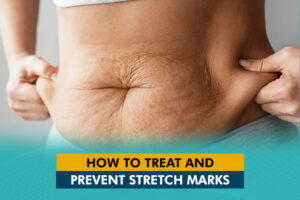 Stretch Marks