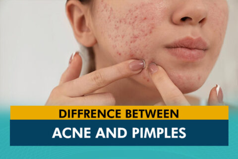 What is the Difference Between Pimples & Acne