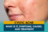 Cystic Acne