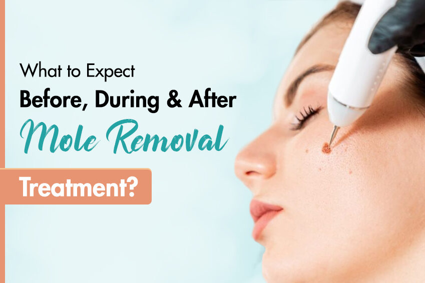 What to Expect Before, During, and After Mole Removal Treatment?