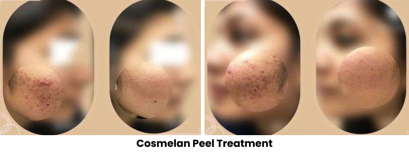 Cosmelan Peel Treatment