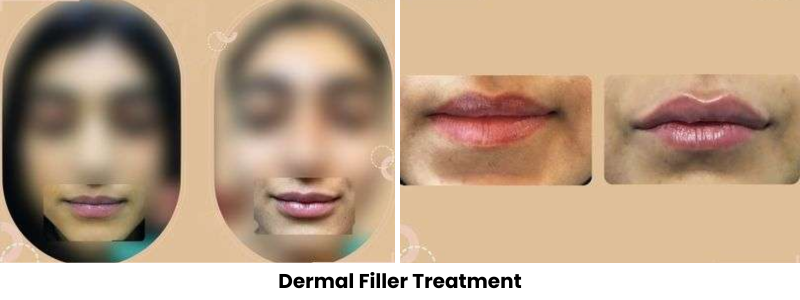 Dermal Filler Treatments