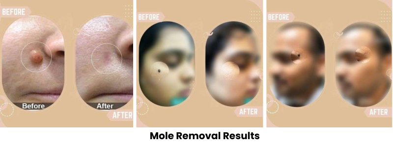 Mole Removal Results