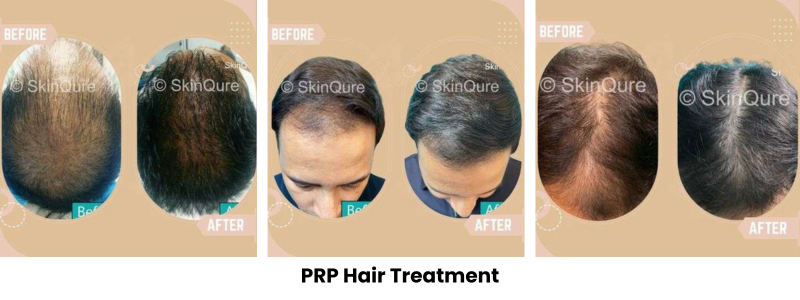 PRP hair treatment 