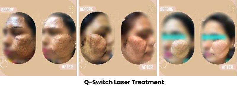 Q-Switch Laser Treatment