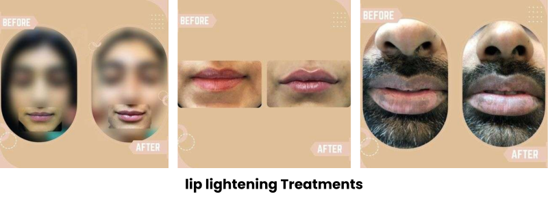 lip lightening treatments