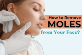 mole removal in delhi