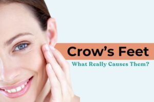 Crow feet treatment
