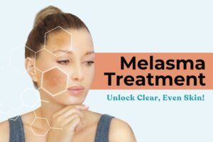 Melasma Treatment