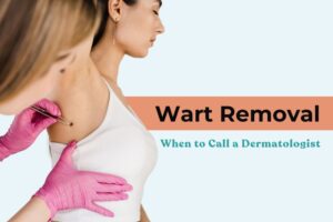 Wart Removal