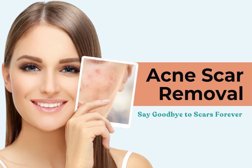 acne scar removal in Delhi