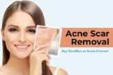 acne scar removal in Delhi