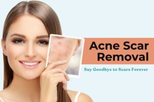 acne scar removal in Delhi