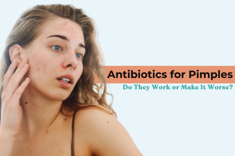 Woman with pimples touching her face, representing the topic “Antibiotics for Pimples: Do They Work or Make It Worse?