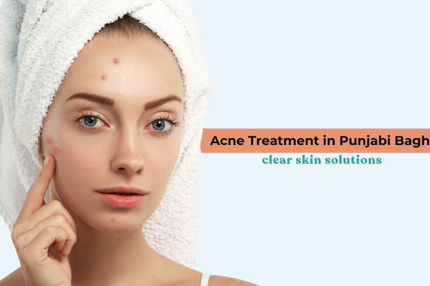 Young woman with towel on head touching acne spots on her face, representing professional acne treatment in Punjabi Bagh for clear and healthy skin solutions.