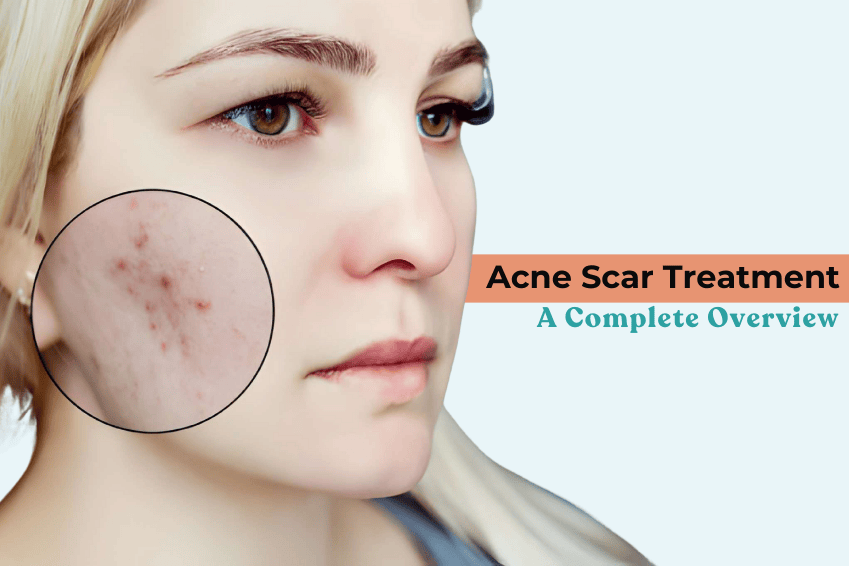 Woman with visible acne scars on her cheek highlighted in a zoomed-in circle, representing Acne Scar Treatment overview.
