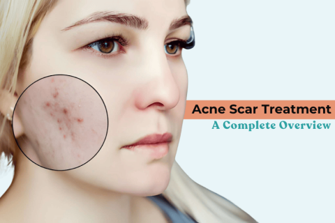 Woman with visible acne scars on her cheek highlighted in a zoomed-in circle, representing Acne Scar Treatment overview.