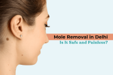 Woman showing a visible mole on the neck with text highlighting Mole Removal in Delhi and its safety and painless treatment options.