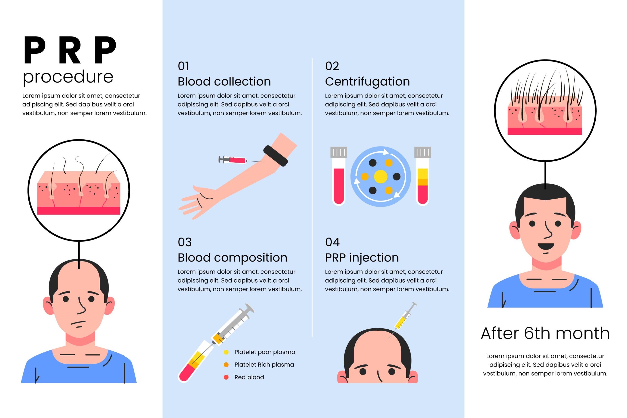 Illustration showing the PRP hair regrowth process, including blood collection, centrifugation, PRP preparation, and scalp injection with before-and-after results.